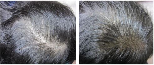 micro haar pigmentatie behandeling pijnlijk