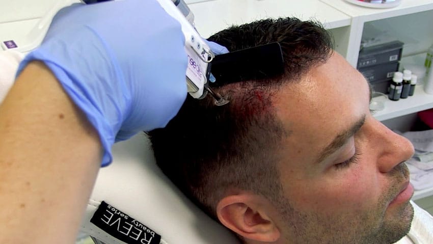 Mesotherapie-haar