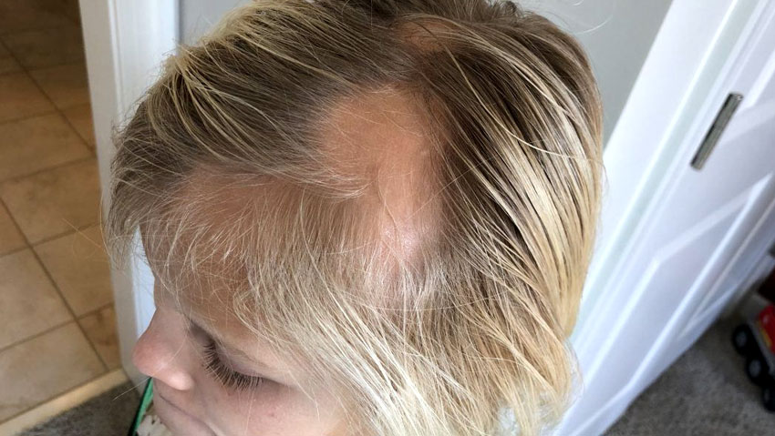 Meisje met alopecia areata