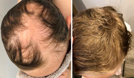 Succesverhaal - Meisje van 5 met alopecia areata