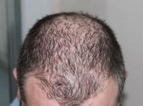 haaronderzoek trichoscan tricholoog