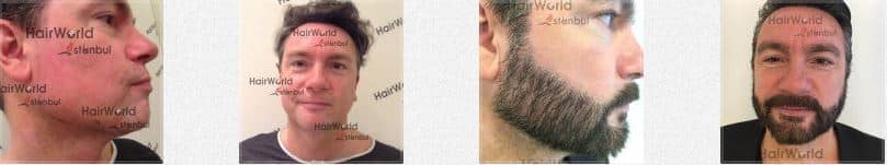 Haartransplantatie baard