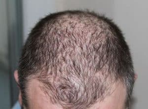 Haaruitval door hitte