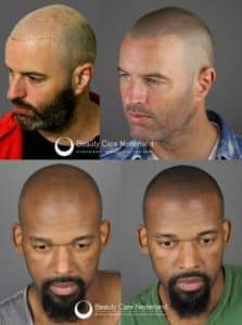 micro haar pigmentatie bekende nederlanders