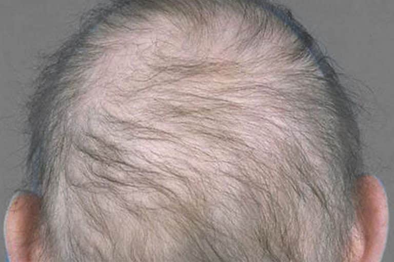 Alopecia Diffusa haarziekten