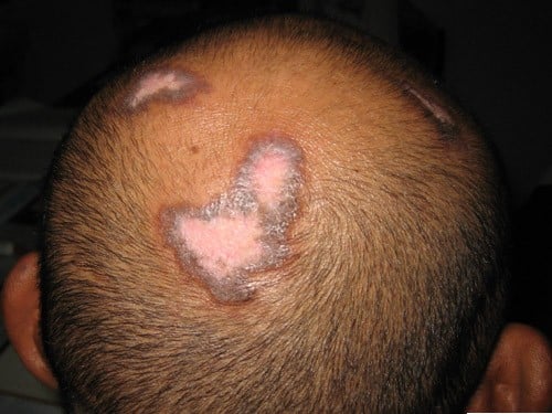 Alopecia cicatricialis haarziekten