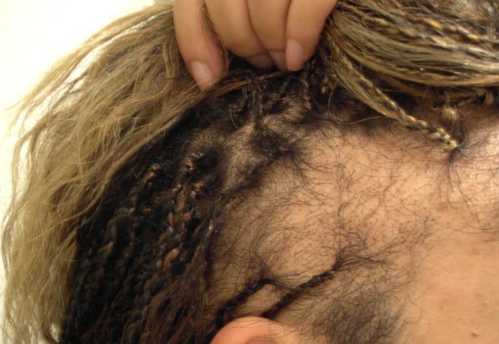 tractie alopecia haarziekten