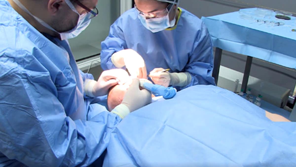 FUE-Haartransplantatie