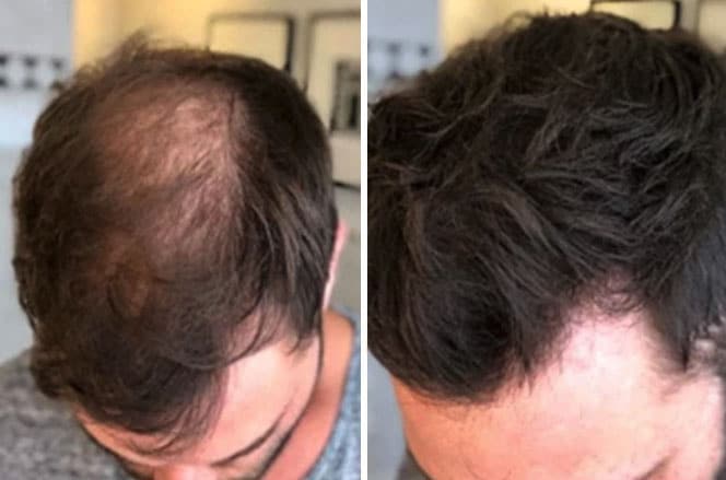 Haarverdikking haarcamouflage