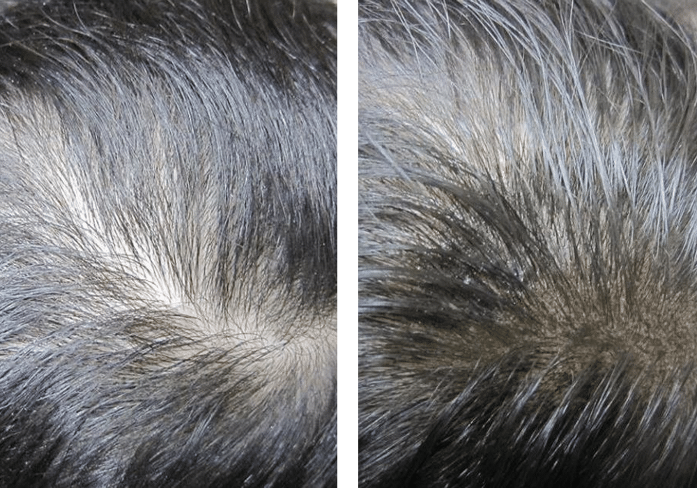 Micro haar pigmentatie bij vrouwen