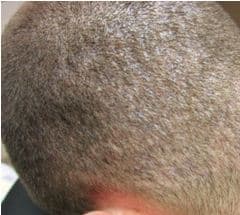 Na micro haar pigmentatie