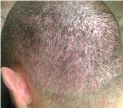 Voor micro haar pigmentatie