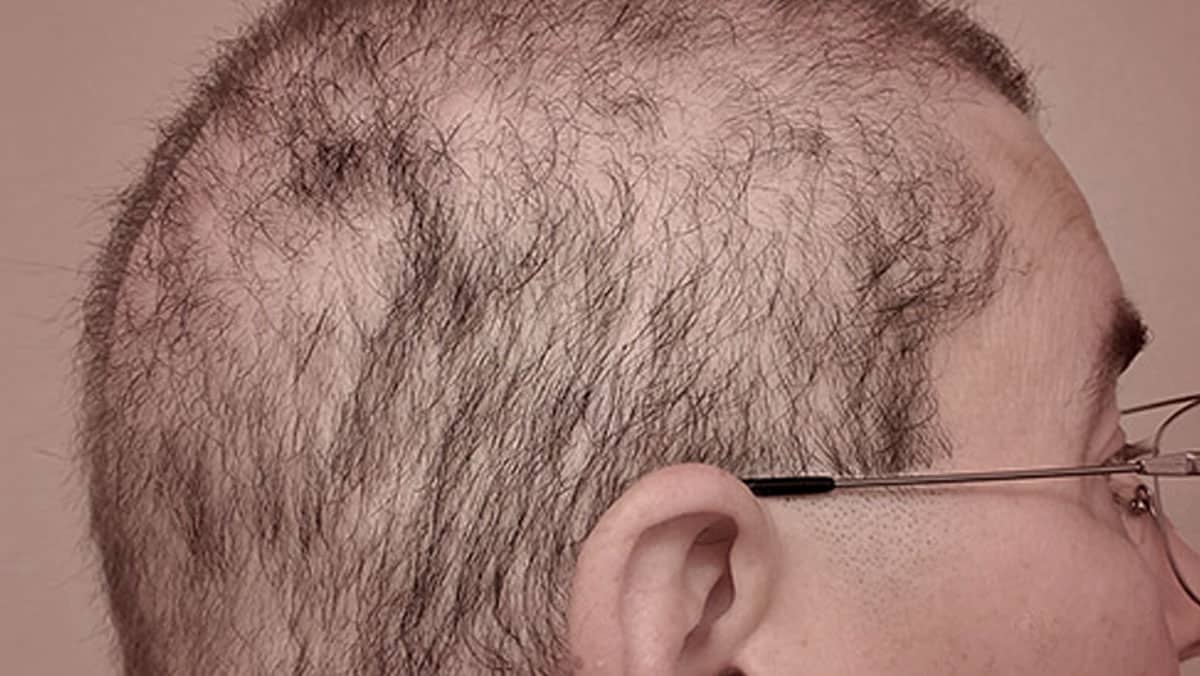 haarproblemen man
