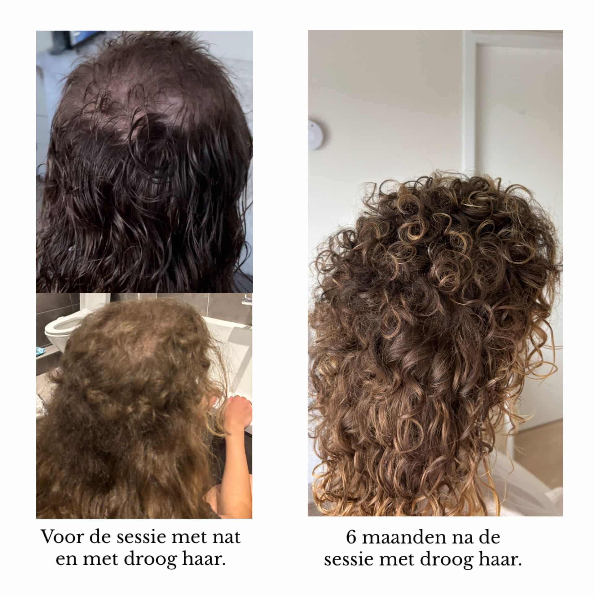 Trichotillomanie haar