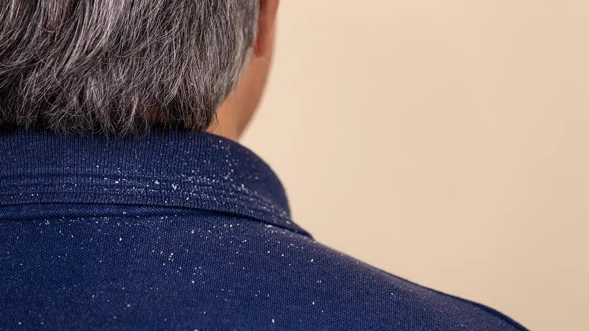 anti roos shampoo aanpak behandelen