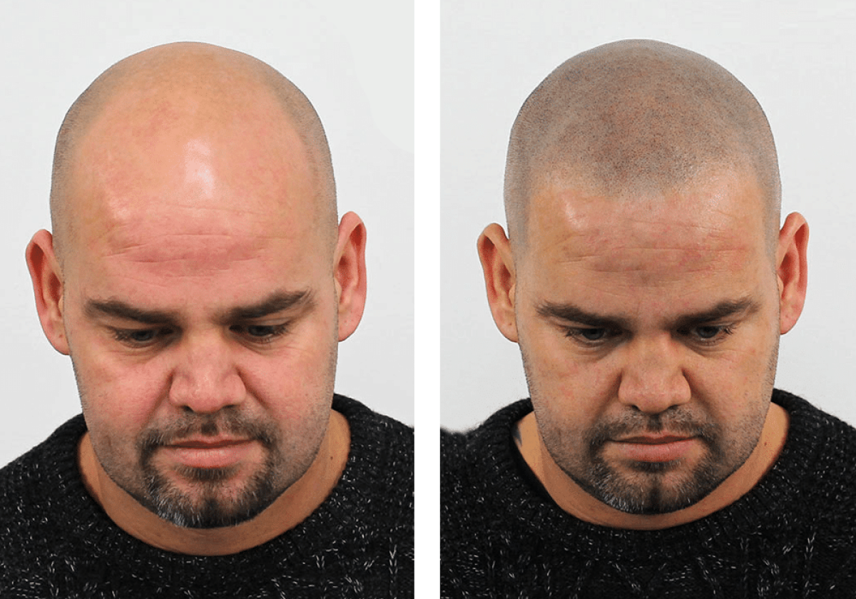 Micro haar pigmentatie resultaten