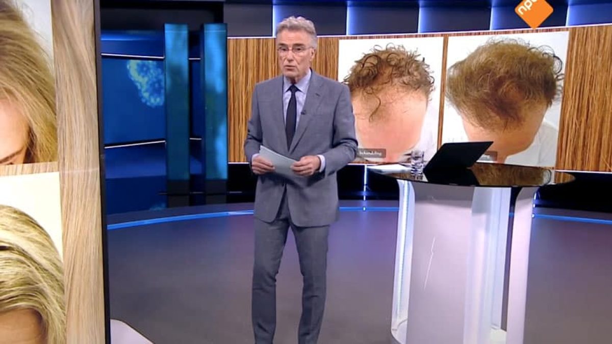 NOS-journaal-haarstichting-haartransplantatie-lockdown