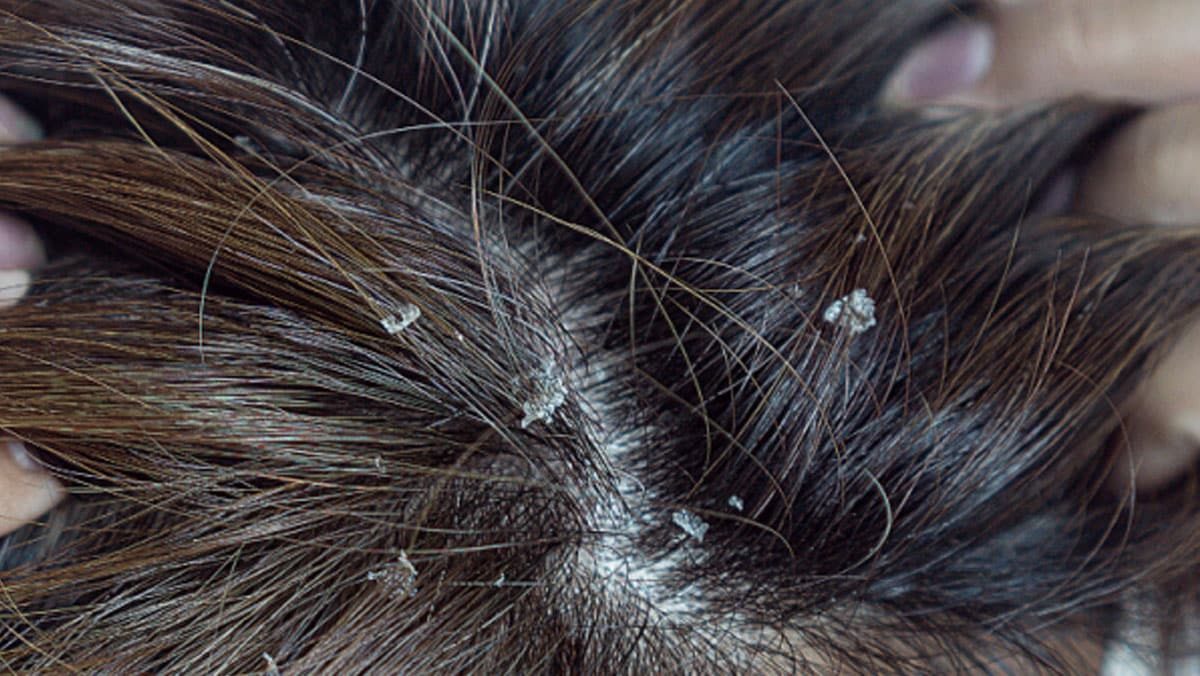 Seborroïsch eczeem hoofdhuid