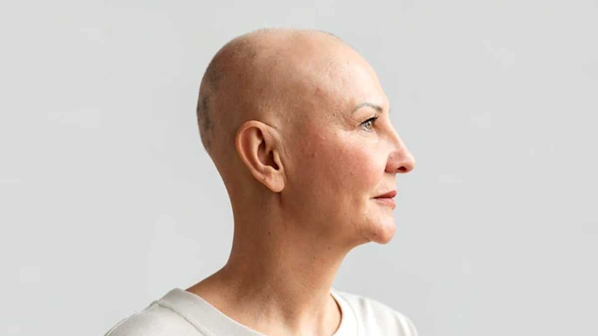 alopecia-areata 4298742
