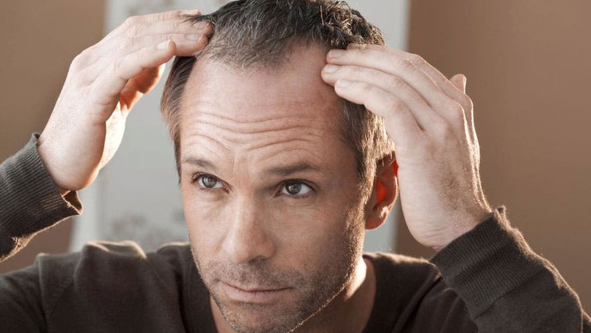 haartransplantatie-factoren