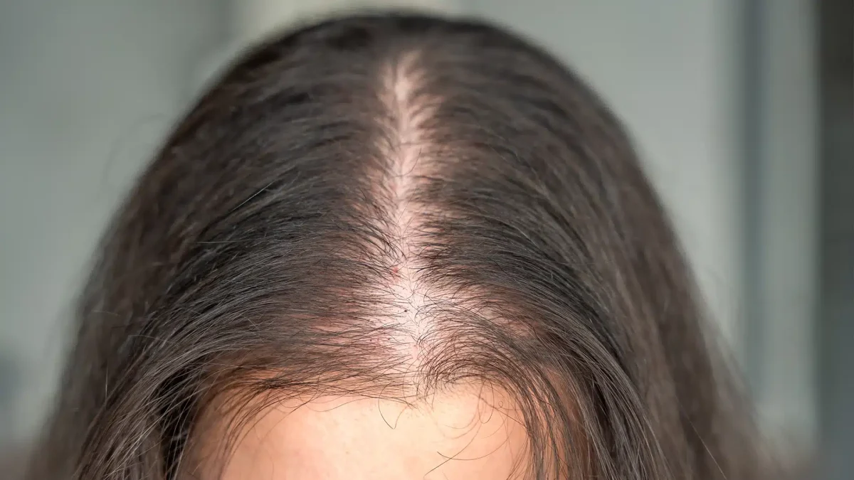 haaruitval dunner haar vrouwen behandeling