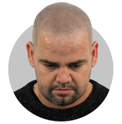 MHP Micro haar pigmentatie
