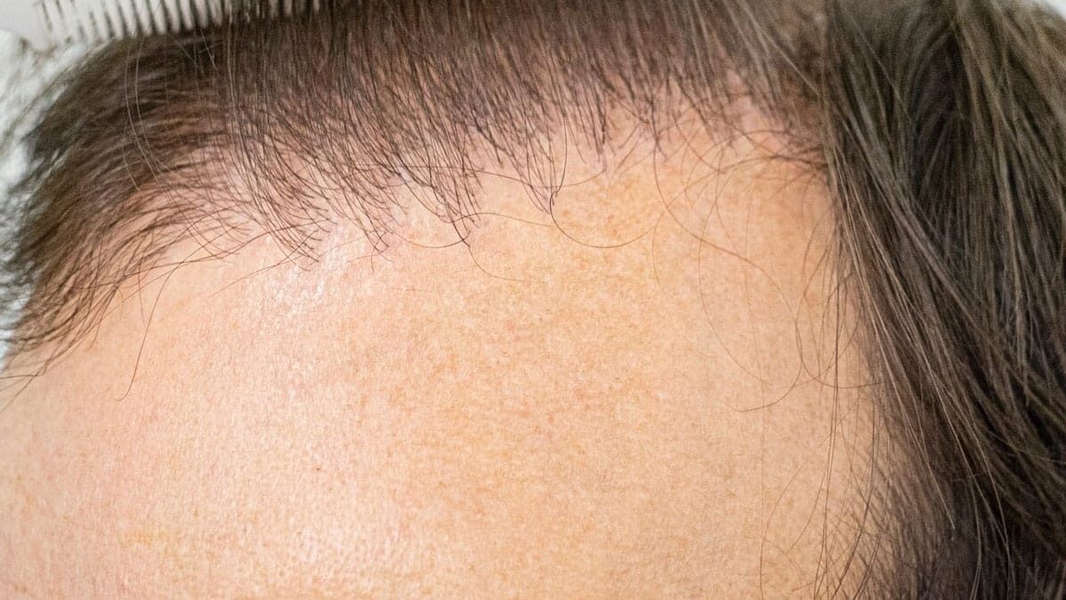 slechte haartransplantatie herkennen